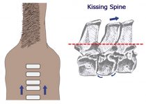 Kissing Spine...What is it? What about my saddle fit?